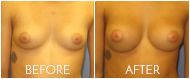 Breast Augmentation Before and After CT