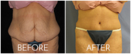 Tummy Tuck Before and After Gallery