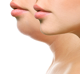 Non Surgical Double Chin Reduction Southbury, CT