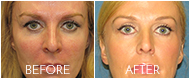 Eyelid Surgery Before and After Gallery