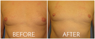 Gynecomastia Before and After Gallery